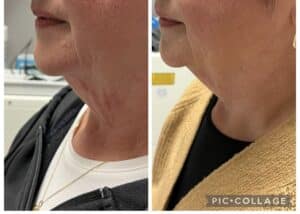 Thermage Neck Tightening Results