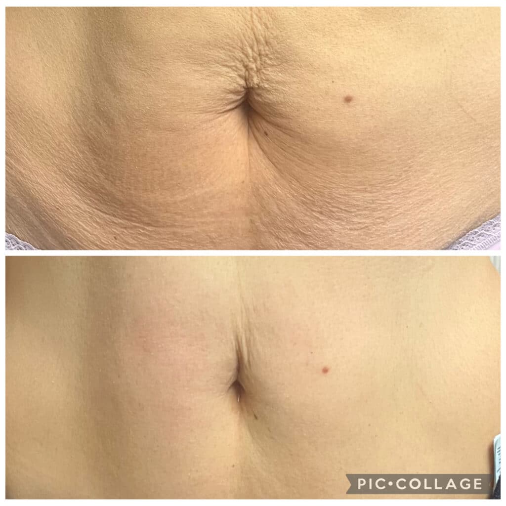 Thermage Tummy Skin Tightening Results