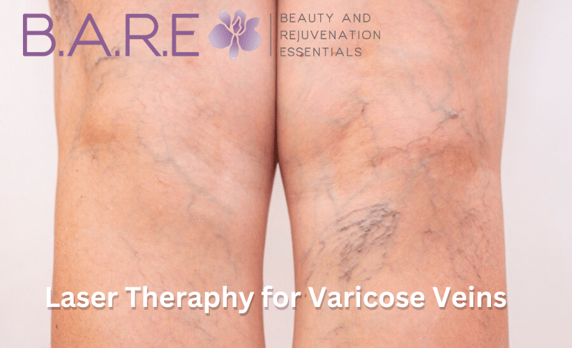 Laser Therapy for Varicose Veins Windsor