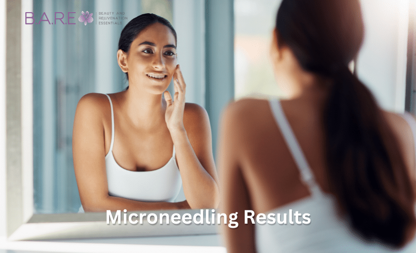 Microneedling Results