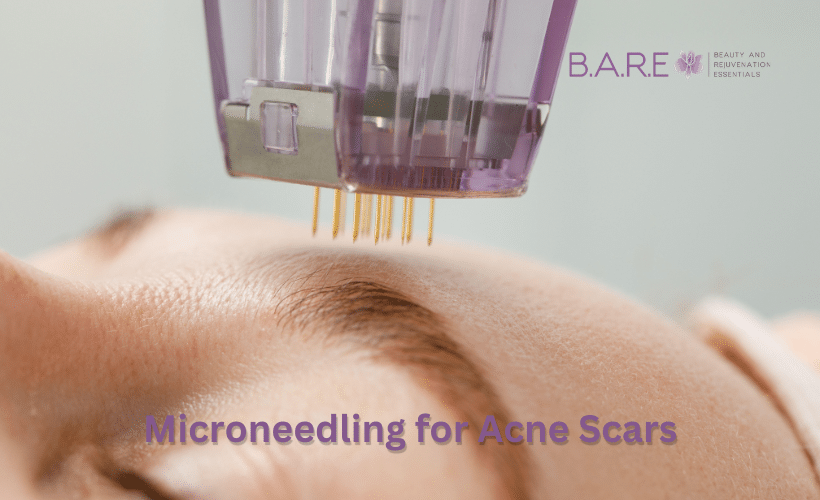 Microneedling for Acne Scars Microneedling for Acne Scars