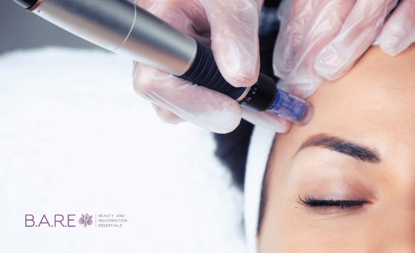 Microneedling session